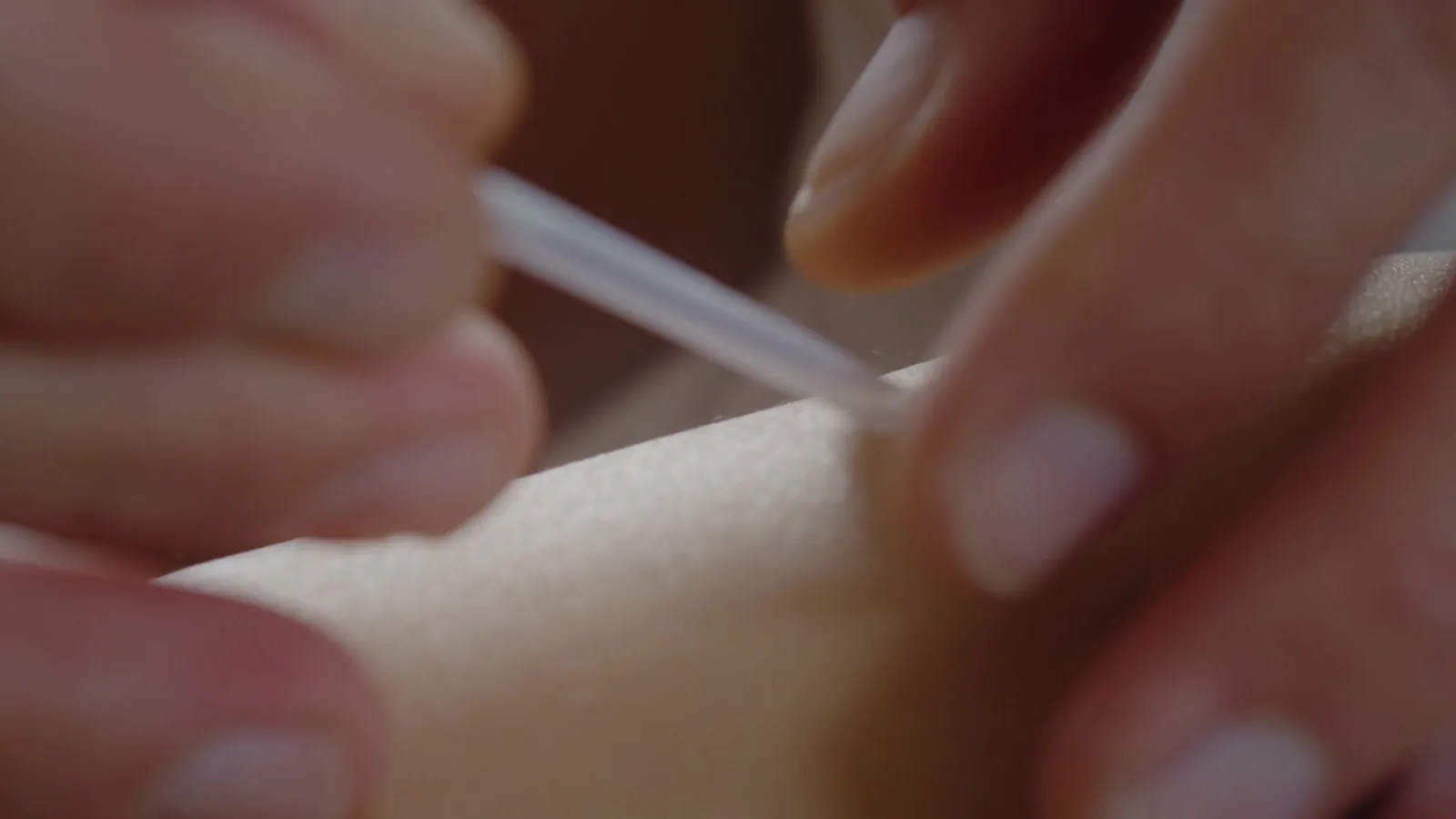 Close-up of a dry needling treatment being applied